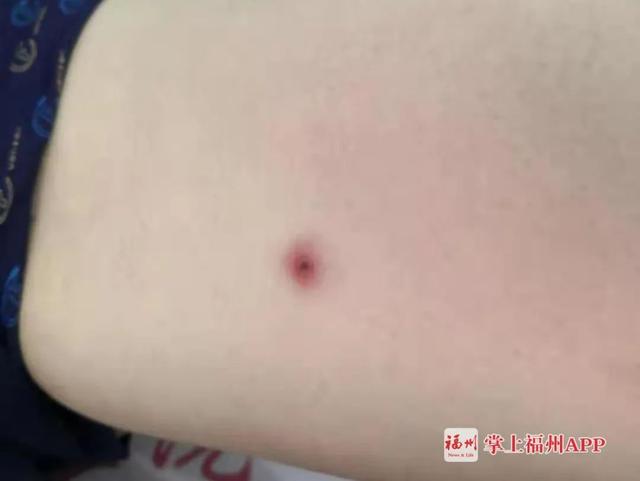 杭州日报|女子发热一周，多次核酸检测后排除新冠！罪魁祸首竟是它，夏季高发多人中招...