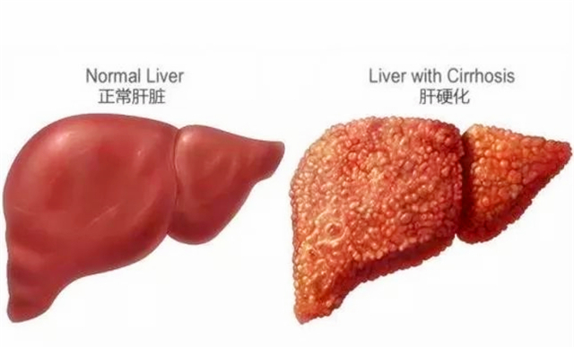 「肝脏」肝硬化的时候，肝脏发生了什么变化？你真的知道吗？看专家的理解
