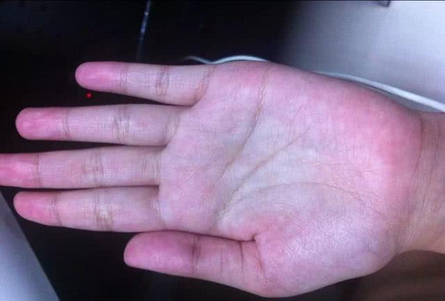 #南瓜#肝不好的人，身上会有“1痛2臭3红”，若一个没有，肝部还不错