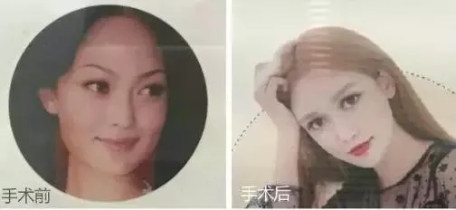 整容|00后高考完扎堆整容，中国的审美, 什么时候沦落到靠整容脸来支撑了?