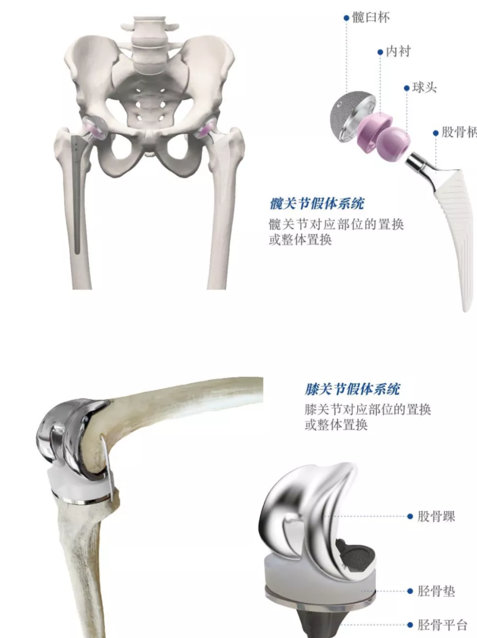 医疗器械|中国股市：骨科黄金赛道的国产第一大龙头（建议收藏）