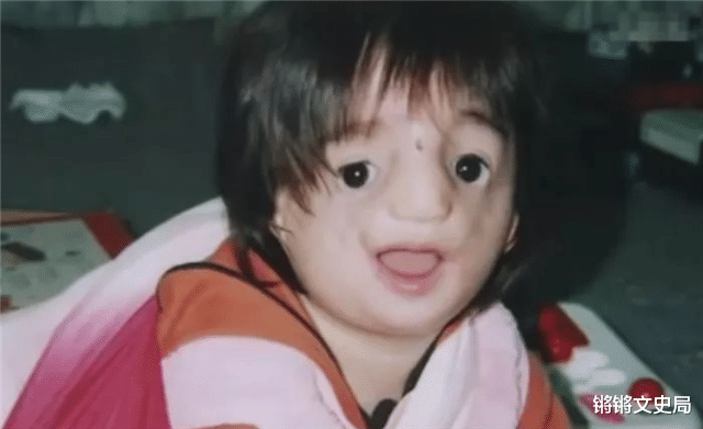 锵锵文史局 日本女孩一出生就患“无脸症”，5万人一遇，25岁活成天使模样