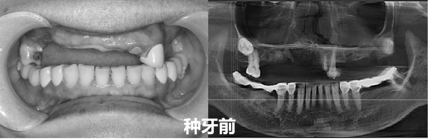 牙齿|她用了15年，修复了一半牙齿