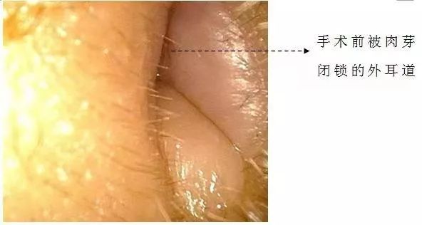 健康广东|【可怕】男子掏耳朵竟然掏出个...差点要命！医生紧急提醒