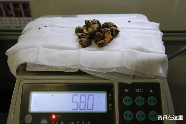 可乐|医生让患者每天4斤可乐连喝一周：消融胃结石便于取出 医生让患者每天4斤可乐连喝一周