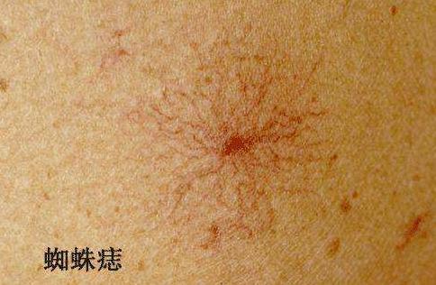 肝脏|肝不好的人，保温杯里常泡点，排肝毒，壮肝阳，肝脏悄悄变好