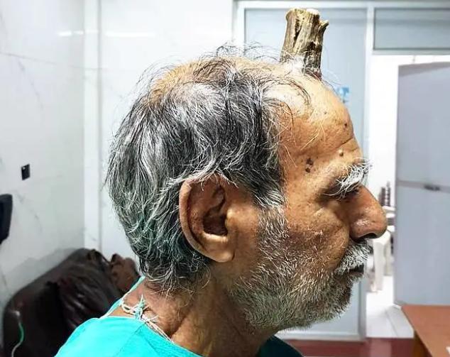 印度75歲男子頭頂長出10厘米“魔鬼之角”，真實版“小龍人”-圖2