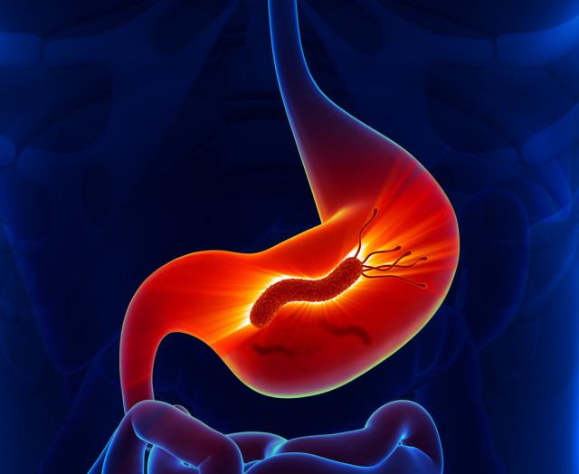 幽门螺杆菌■幽门螺杆菌:感染44亿人的一级致癌物,感染上了就要吃药吗?