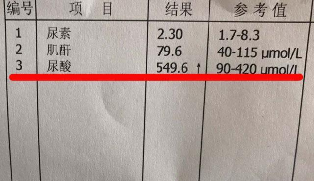 尿酸|52岁男子，尿酸值从589到253，或和坚持了4个习惯有关