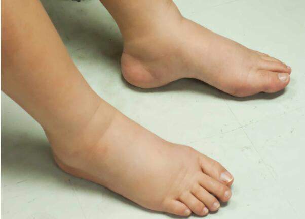 尿毒症|尿毒症总是静悄悄?身体3个部位早露出“破绽”,很多人不以为然