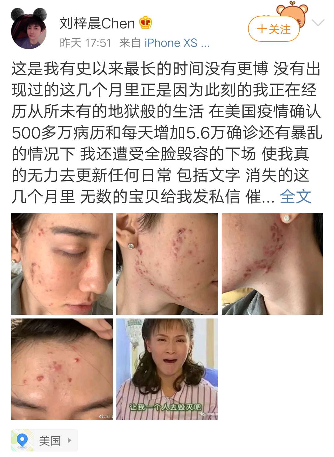 毁容|网红刘梓晨在美国发文：正经历地狱般生活！全脸毁容还被网友“恭喜”