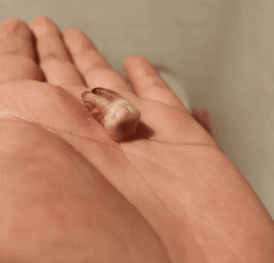 [肺癌]“医生说消肿才能拔，我半夜起来就给拔了，结果...”哈哈哈评论区炸锅了