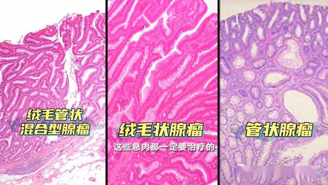 肠息肉|发现肠息肉就应立即切除，是真的吗？
