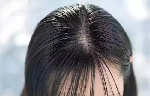 脱发|头发爱出油怎么办，还伴有掉发真是心累！