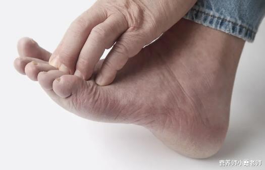 用药指南@提醒糖友:“脚部”出现4种表现,小心并发症,控血糖,做好5件事