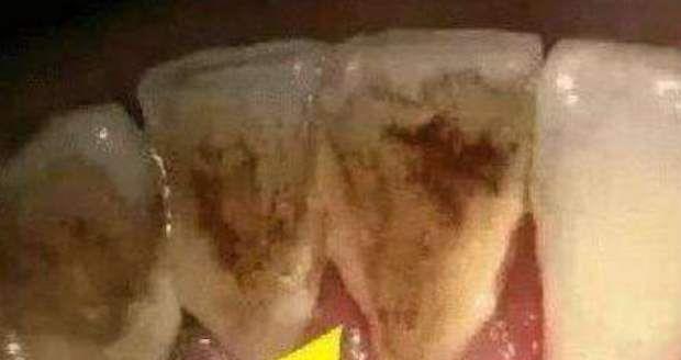 「牙齿」为什么有的人牙齿是上会有很多“黄泥”？教一招