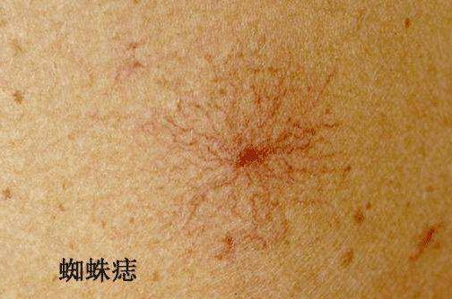 肝癌|46岁男子，不碰烟酒，确诊肝癌，医生：这件事做太多，伤肝不浅
