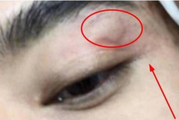 蚊子|演员被蚊子叮了，整个剧组停工，看到照片后却没人说他耍大牌