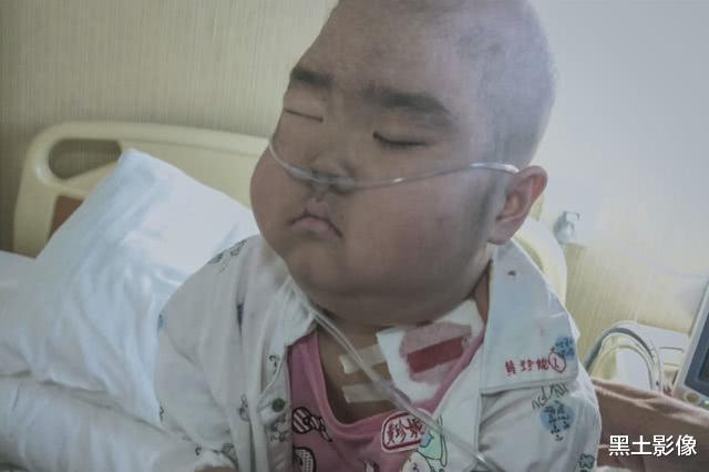 抗癌@7岁“小萝莉”患重症4年样貌大变,今被医生禁食3个月瘦成皮包骨