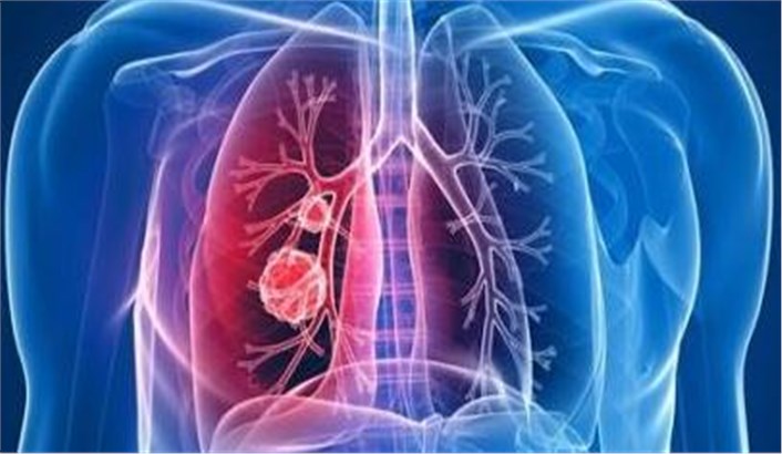 『』肺癌早期的体征与常见表现