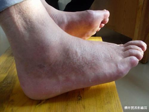 痛风|总会痛风发作的人,这3种“水”要撤离餐桌,多喝会加重病情