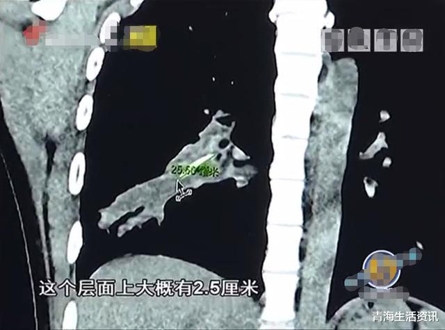 咳嗽▲少女因“手汗症”就医，却治好了14年的咳嗽！CT拍出2厘米异物