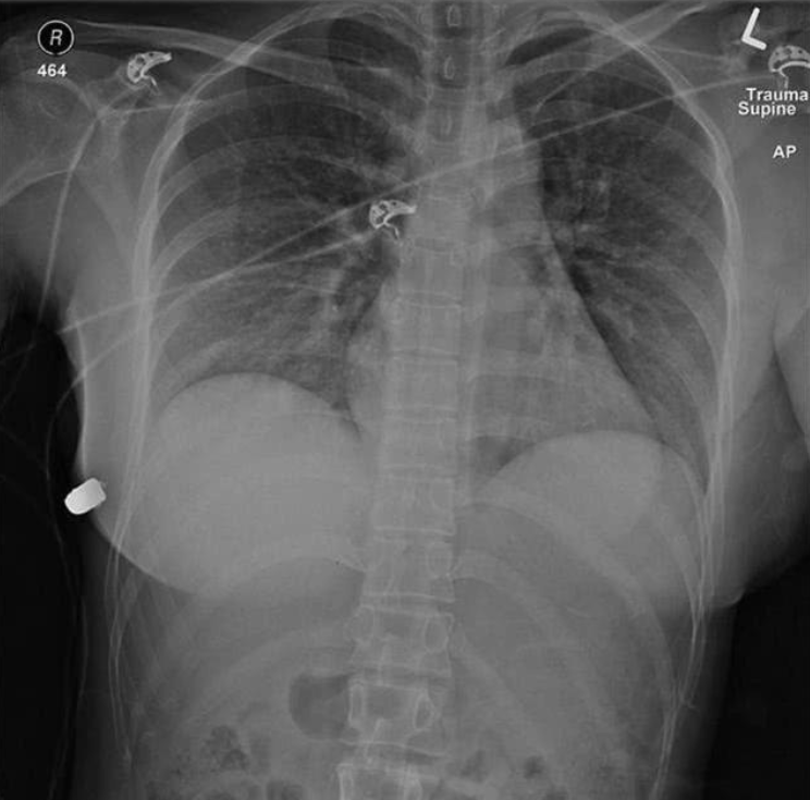 『医学』假奶发威！女子胸部中弹“硅胶让子弹转弯”登上医学文献