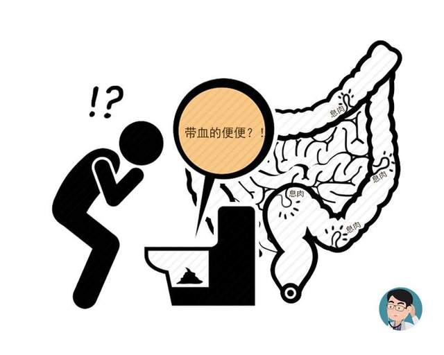 直肠癌|一个不起眼的排便习惯改变，却是晚期直肠癌的“信号”！别再忽视