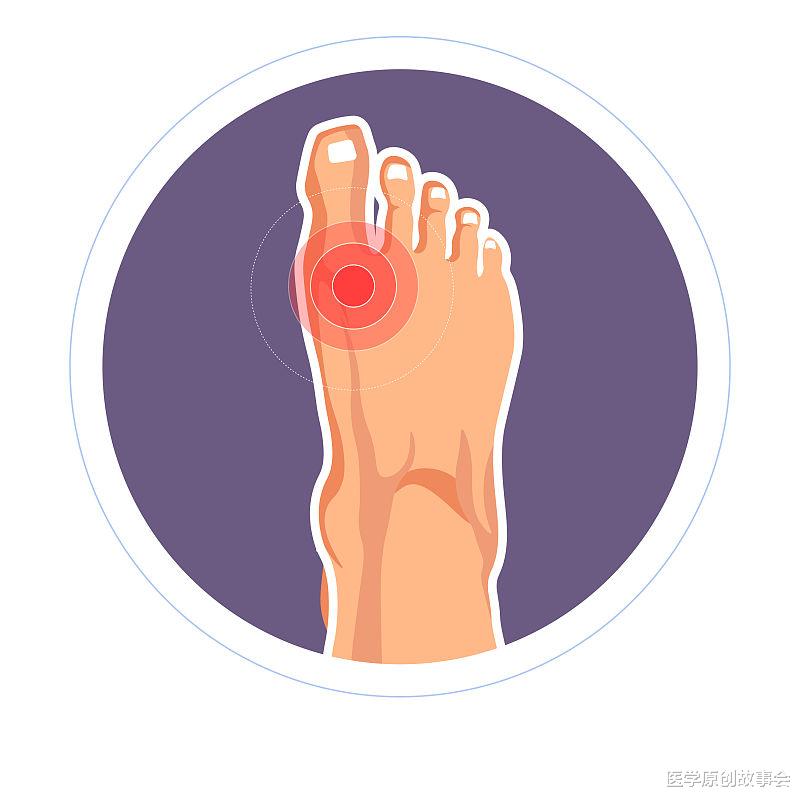 尿酸|真正降尿酸的四个秘诀，多喝水排在第二位，排在首位的你很少坚持