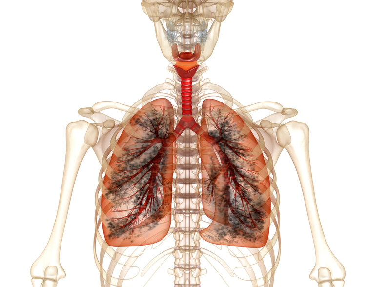 39肿瘤|石棉是一级致癌物，潜伏期长达20-50年，太多人不能及时发现！