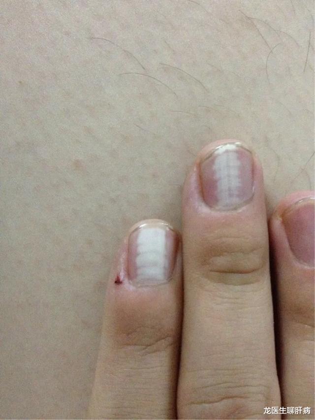 脑梗|肝不好的人,手上会出现哪些信号?请收下医生这份用心的回答!