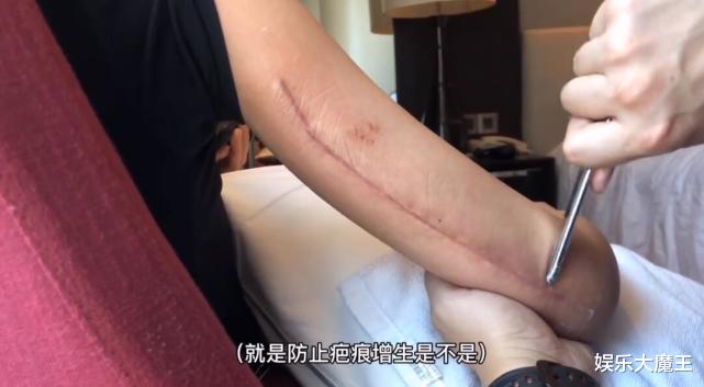 万茜|万茜骨折恢复太快被嘲“医学奇迹”,工作室首度公开手术伤口令人触目惊心