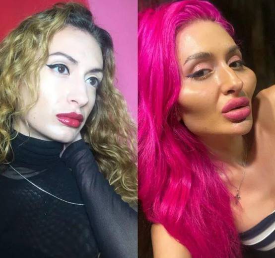 秦昊|沉迷整容的网红，没钱去医院，自己给自己打针，结果整成这样