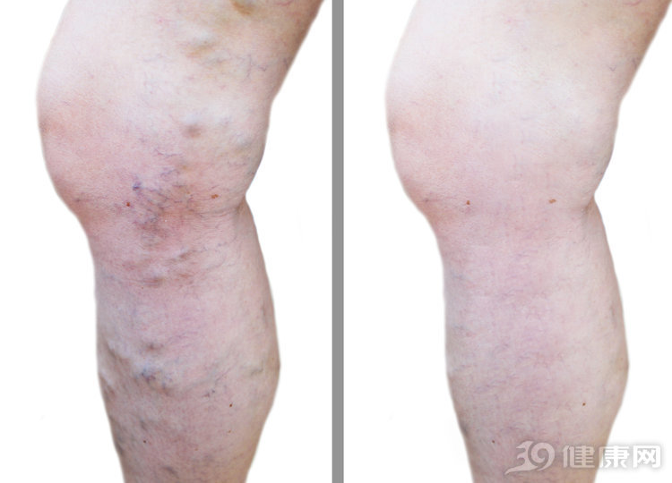 「祛湿」男子的脸莫名其妙肿了，脖子也变粗，医生一查不得了！