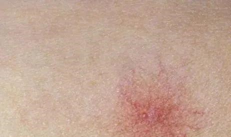 肝脏|女子长出小红点，确诊肝硬化，医生：皮肤出现1种变化，警惕肝病