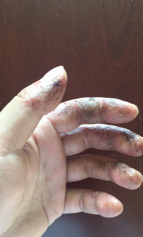 |望大V能够分享一下|真实经历分享#钓鱼人#职业病之香虎手治疗方案