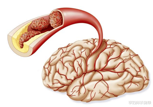 心脑血管疾病|颈动脉出现硬化斑块,必须吃他汀和阿司匹林?本文辟谣讲出实情