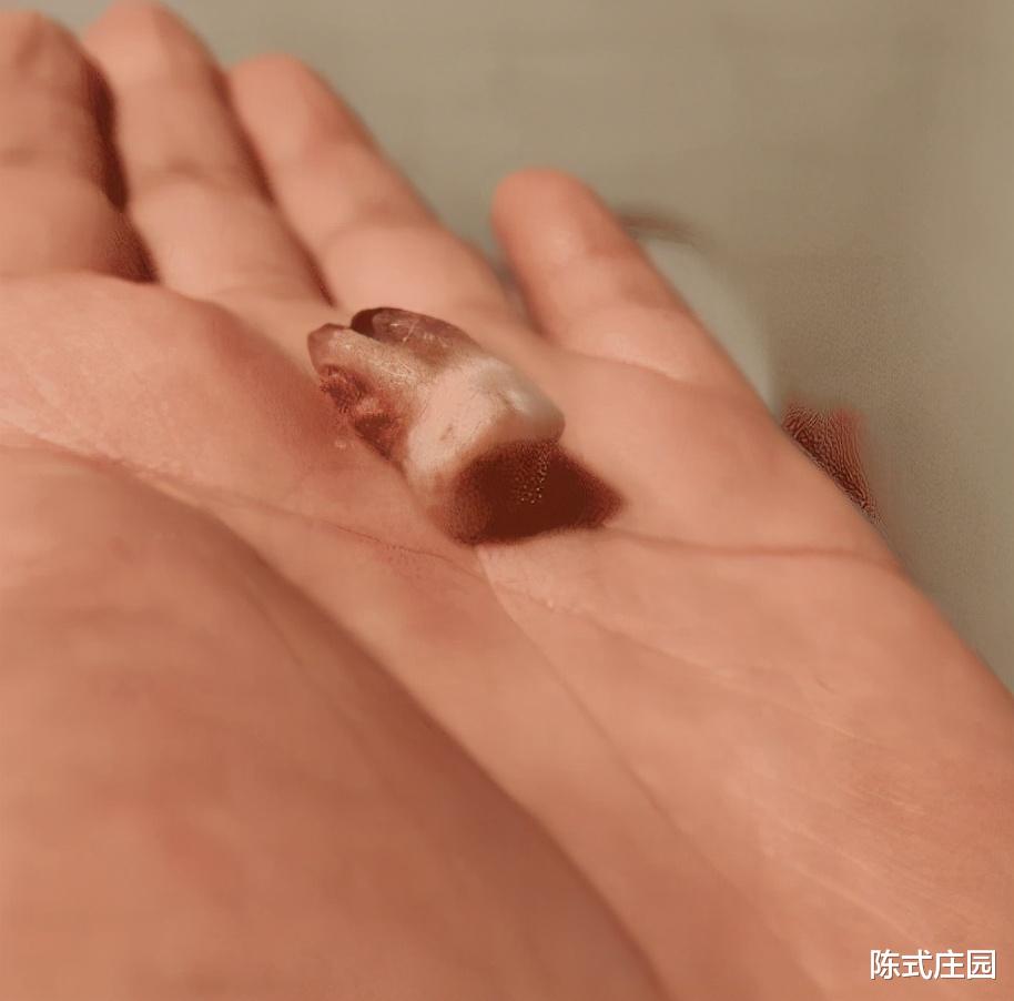 医生|医生说消肿才给拔，半夜起来我就给拔了