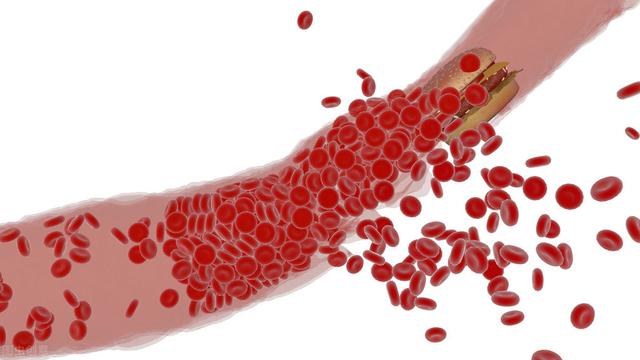 银耳|如何养护血管预防中风？