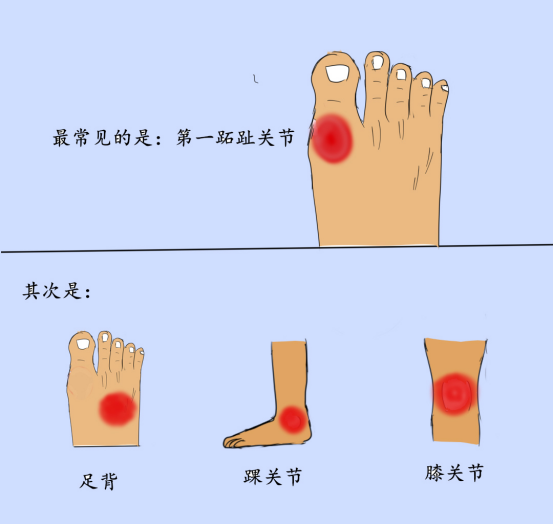 尿酸|年纪轻轻就有痛风，这到底是个啥毛病