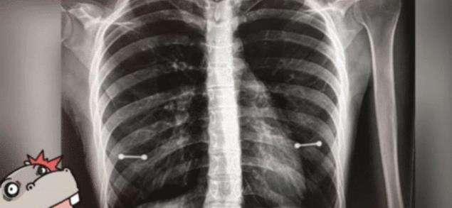 【x光片】女子X光照片中多了两根棒棒，医生解释后，妈妈脸都青了！