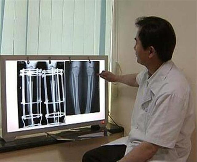 军人|当年那个宁愿花16万，也要断骨增高7.2厘米的男孩，后来成功了吗