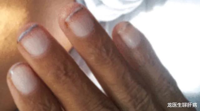 脑梗|肝不好的人,手上会出现哪些信号?请收下医生这份用心的回答!