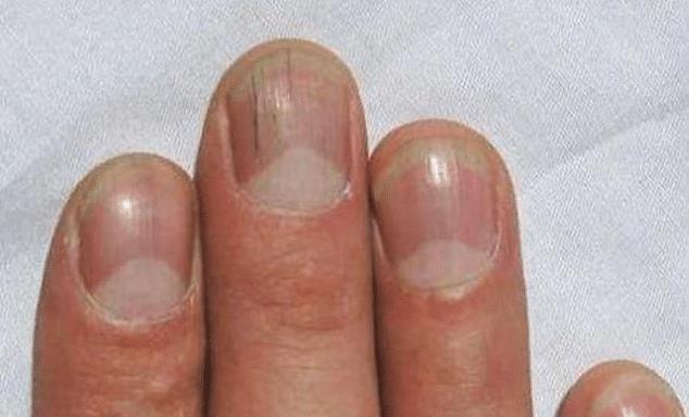 「贫血」指甲上出现竖纹,可能与3种疾病有关,为了健康,不妨提前了解