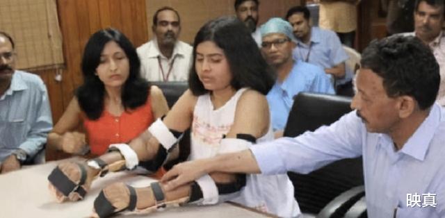 印度女孩因車禍失去雙臂，移植瞭黑人的手臂後，皮膚開始變黑-圖2