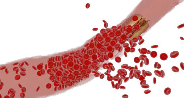 『癌细胞』癌细胞转移到底有哪些危险因素，体内竟然有促进转移的推手