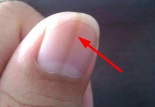 「贫血」指甲上出现了竖纹？可能跟这4个健康隐患有关，别不当回事！