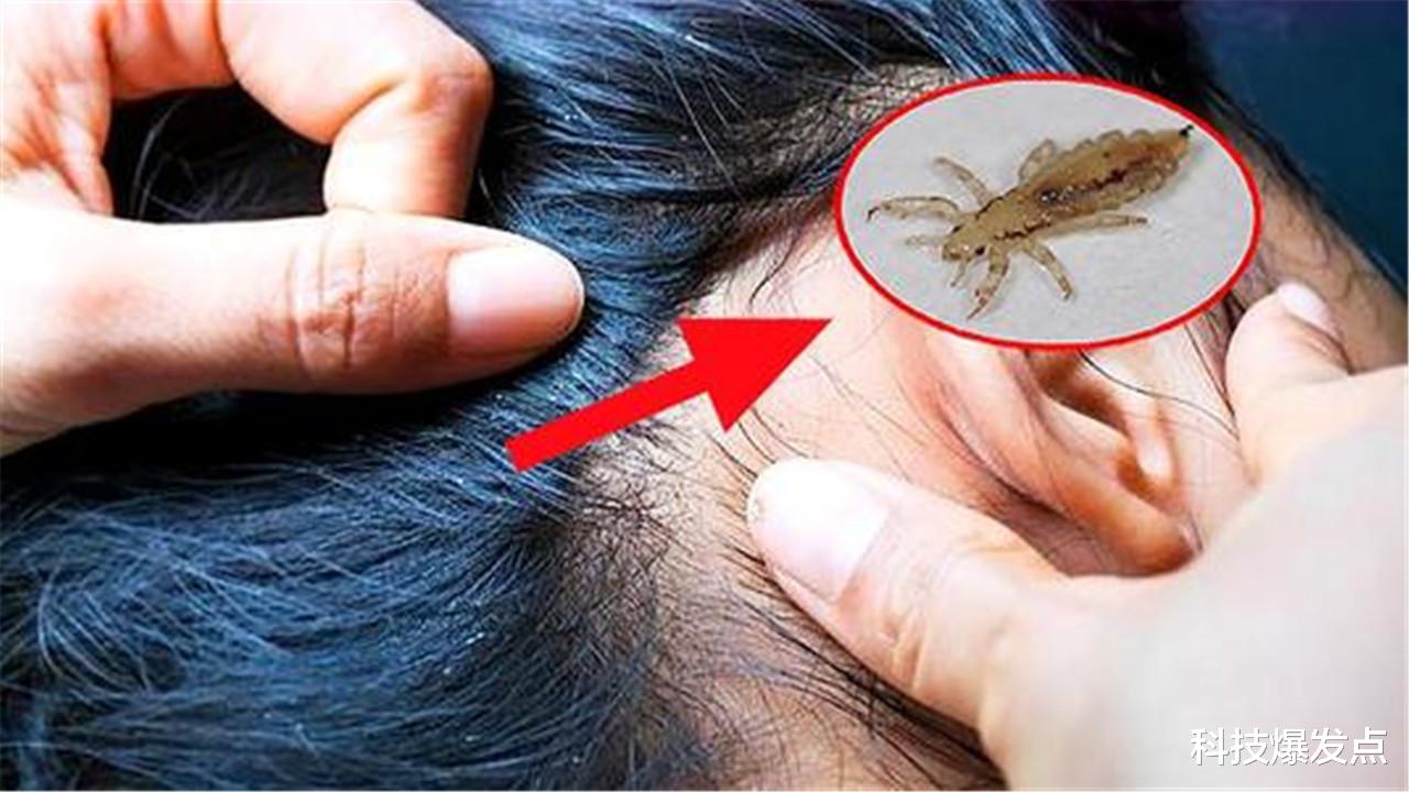 |40年前,为何人人的头上都有虱子?现在又为何消失不见了?