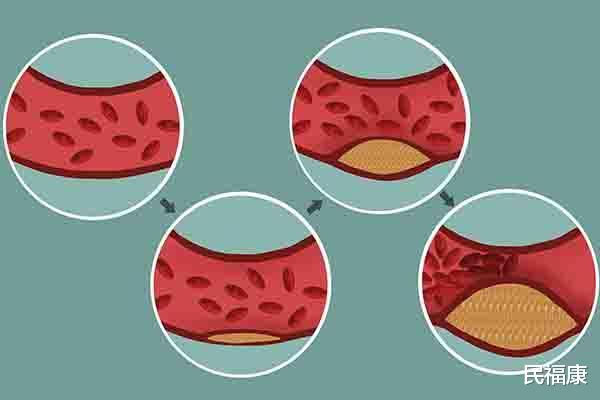 【肝脏】高血糖是如何形成的?总算弄明白了,正常人也不能忽视