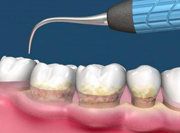 「牙结石」40岁女子口臭严重，医生发现嘴巴里有“石头”，情况很尴尬